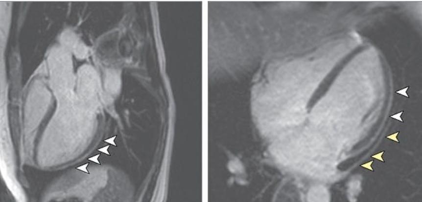 新冠病毒导致心肌受损,新冠病毒侵蚀心脏后遗症