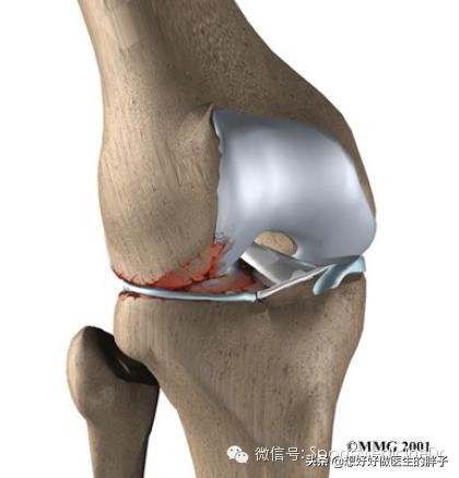 半月板损伤通常是单膝还是双膝,你知道半月板是什么吗