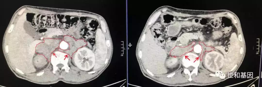 精益求精，抗血管和免疫药物的临床应用经典病例丨束永前教授