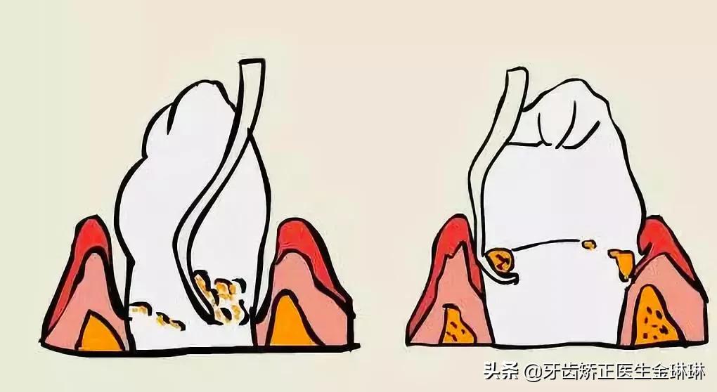 有肾病的人得了牙周炎怎么办,得了牙周炎用什么牙膏刷牙最好