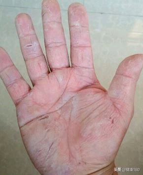 手部季节性脱皮有哪几种,手部脱皮严重是什么样的
