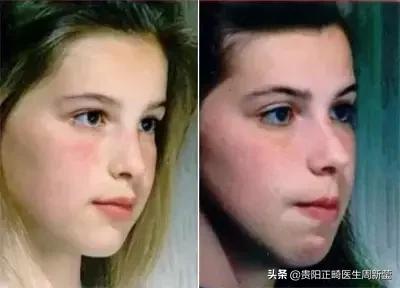 12岁前必须解决的错颌畸形,孩子十二岁牙畸形怎么办