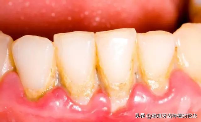 为什么换完牙齿后牙齿还会松动,换过的牙齿松动是什么原因