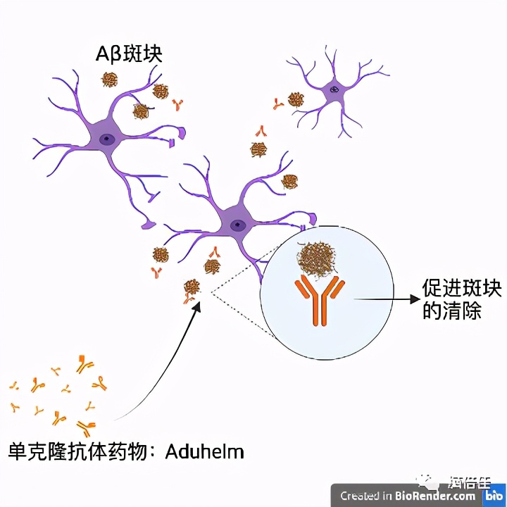 「全浸英语阅读」AlzheimersDisease阿兹海默症的微光