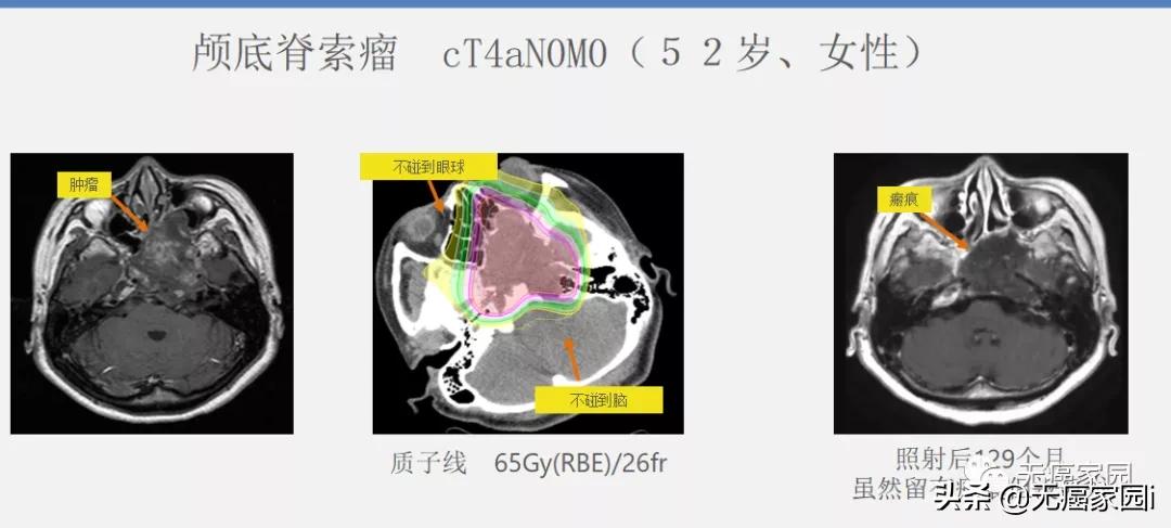 质子治疗手术适合大型肿瘤,肿瘤不能根治吗