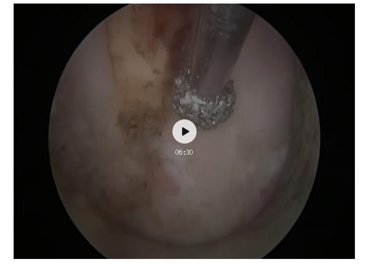 脊椎狭窄压迫神经腿疼怎么治疗,神经根痛上肢麻木怎么康复