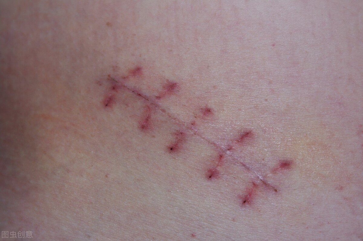 留下的伤疤怎么去掉,好了的伤疤怎样能去掉