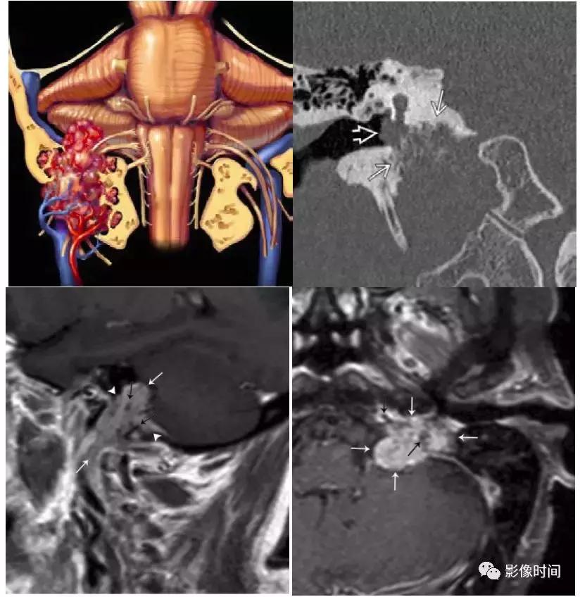 双侧颈动脉鞘间隙多发小淋巴结影,双侧颈动脉间隙多软组织密度结节