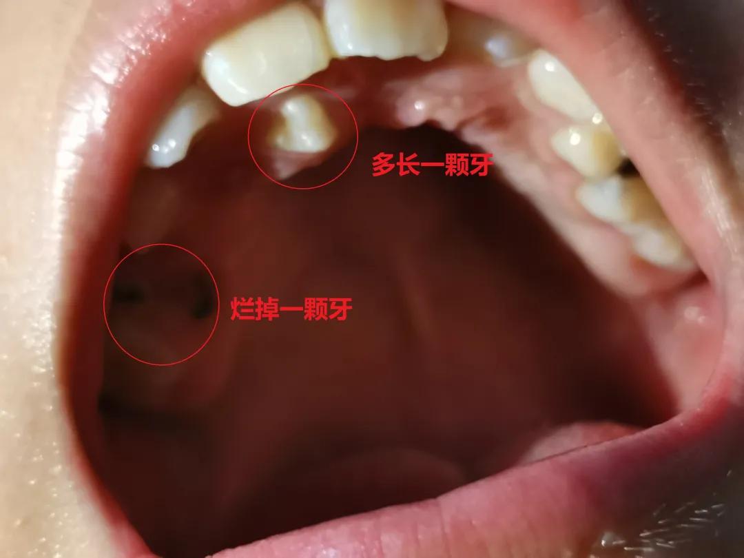 儿童看牙保险能报销吗,平安少儿齿科保险怎么样