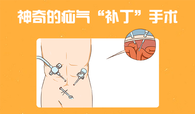 同样的手术为什么有的人恢复得好,直疝手术复发率高吗