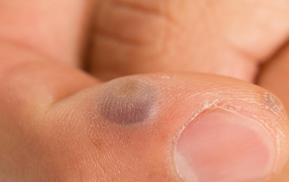 自体脂肪填充能去掉法令纹吗,去掉法令纹用什么护肤品好