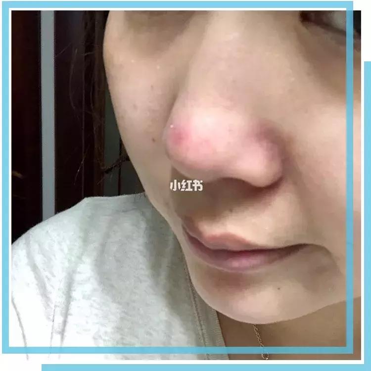 如何有效的祛痘印医美面膜,消炎祛痘的医美面膜