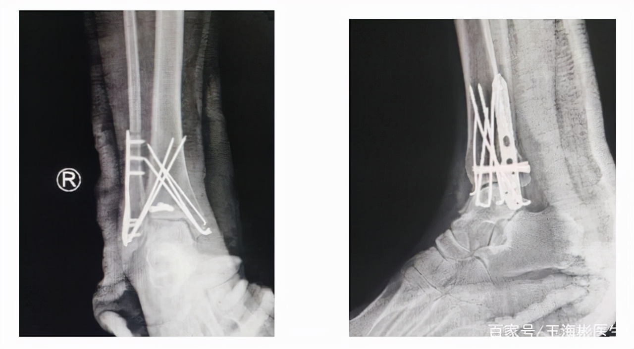 脚崴了怎么迅速正确处理,崴脚了怎么办正确处理最重要