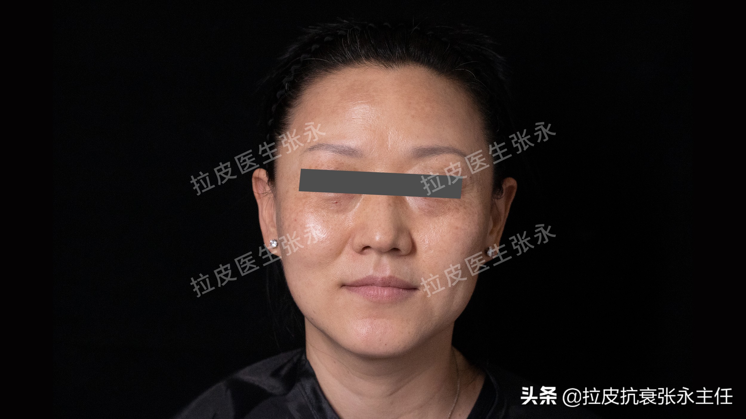 内窥镜小切口拉皮线会不会断,内窥镜拉皮和小切口拉皮哪个好