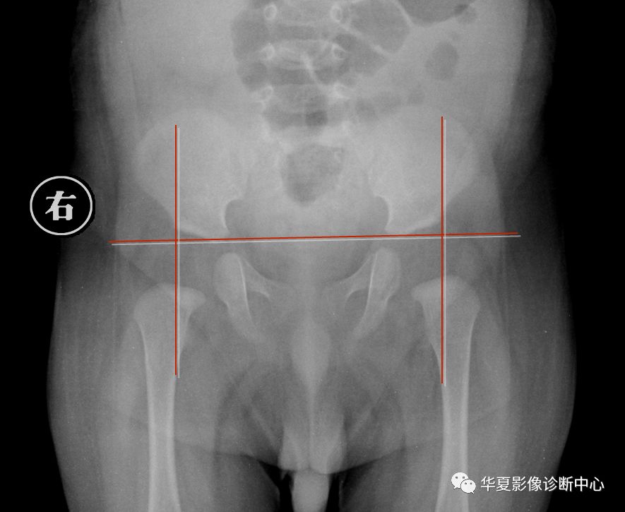 先天性髋关节脱位截骨术全过程,先天性髋关节脱位可以考驾驶证吗