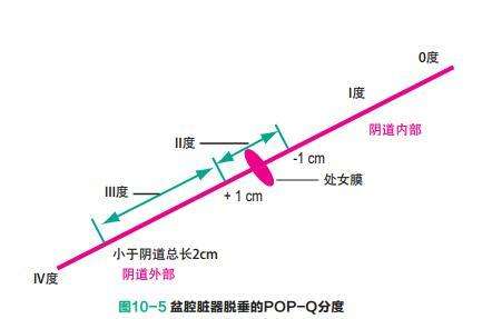 Ella生育后遗症：打喷嚏、跑步都会尿*禁失**！产后这样做可预防