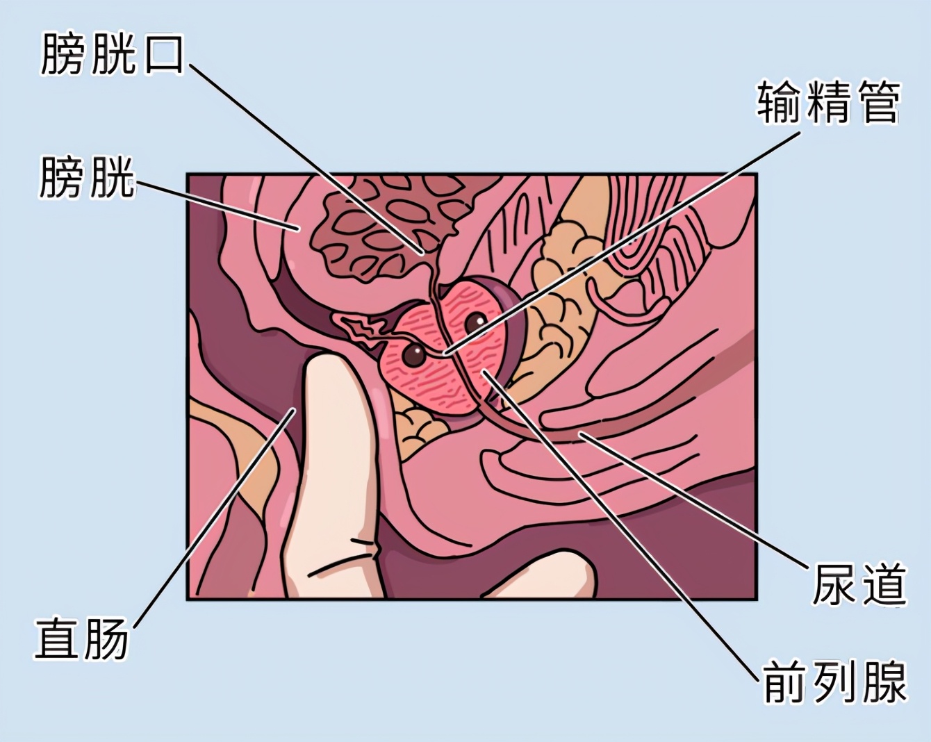 前列腺导致的疼痛,前列腺引起腰腿疼痛有多痛