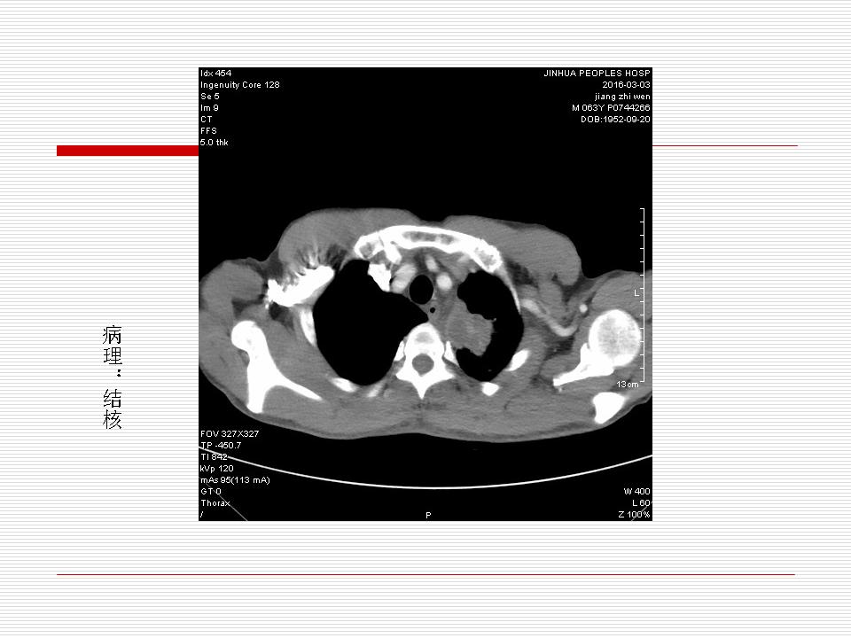 像炎症的肺癌能治好吗,医生说可能是肺癌也可能是炎症