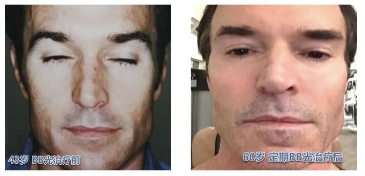 追求素颜肌必做项目之光子嫩肤——皮肤的“十全大补丸”