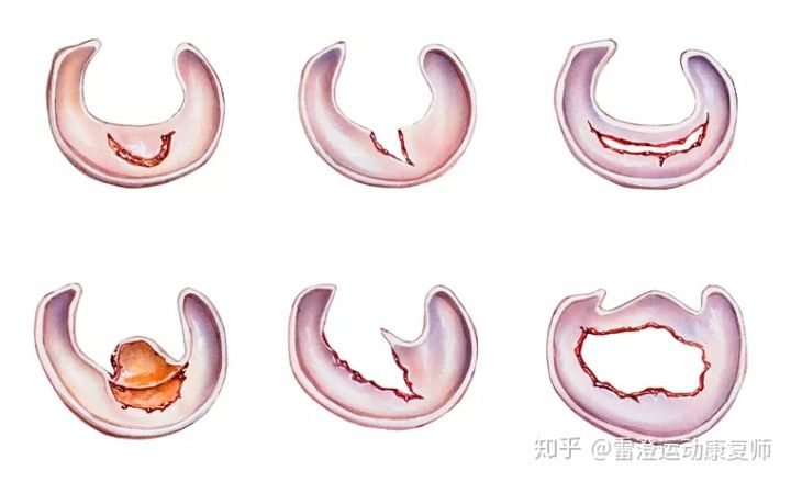svf治疗半月板损伤,svf治疗软骨磨损