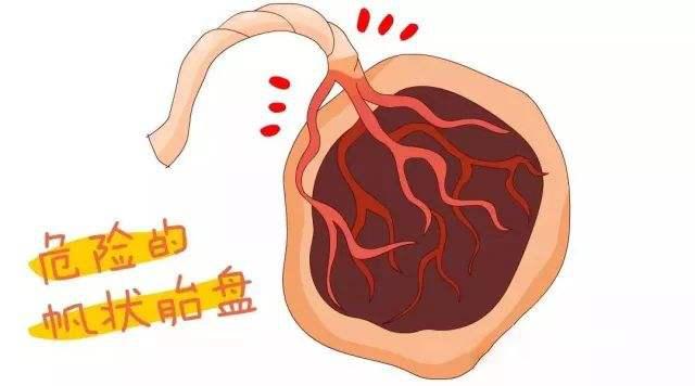 这个孕期凶险的情况，早了解早提高警惕