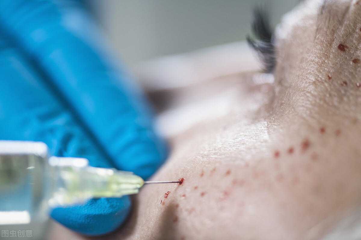 治疗黑眼圈最有效的产品,prp治疗黑眼圈需要做几次费用多少