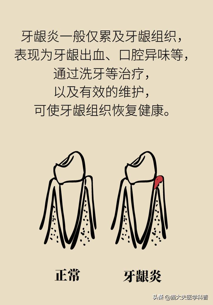 牙龈肿痛牙龈出血是啥原因引起的,牙龈肿痛出血是胃火大引发的吗