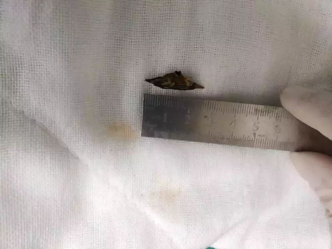 喝了爸爸一碗粥，一岁多孩子肠穿孔..医生曝光原因让所有人震惊