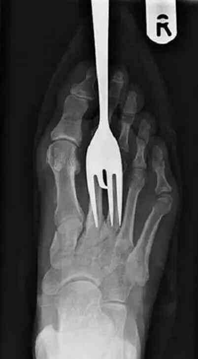 不作死就不会死，看看这些被人类搞进身体里的异物