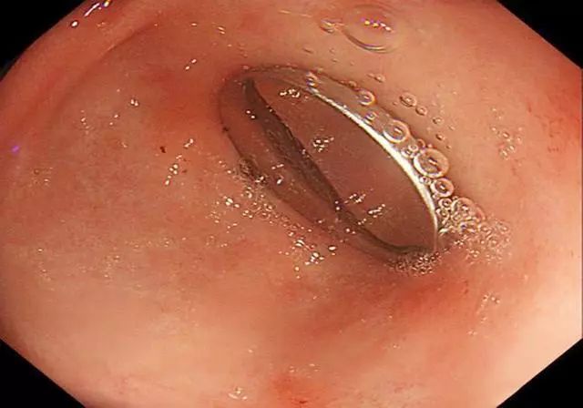 小孩吃电池腐蚀食道后果,7岁小朋友误吞异物怎么处理