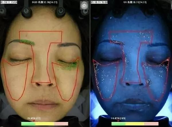 脂肪粒怎么用针挑出的,脂肪粒多久可以用针挑出来