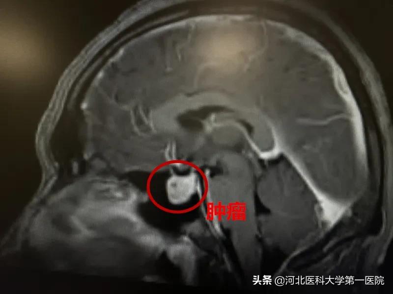 神奇魔法刀,一点就消!点亮肿瘤绝境患者,再生的希望之光