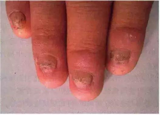 指甲竖纹发白变厚是怎么回事,涨知识了说明什么