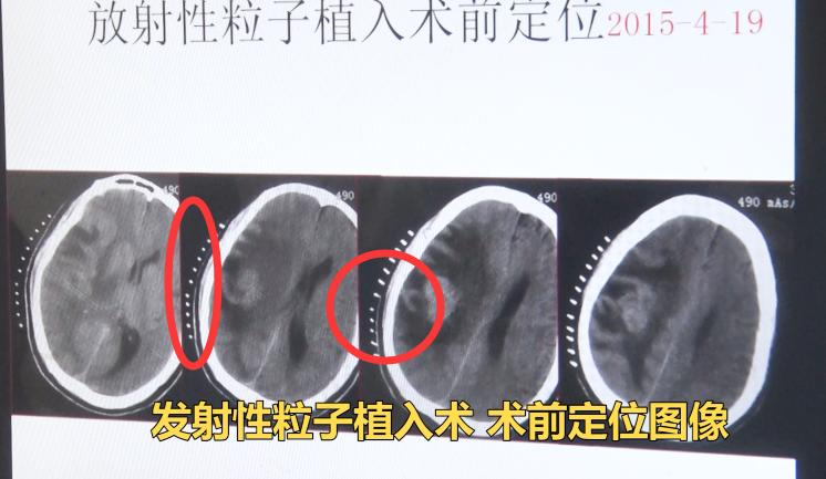 肺癌转移到脑癌死前3个月症状,48岁女子肺癌晚期死亡