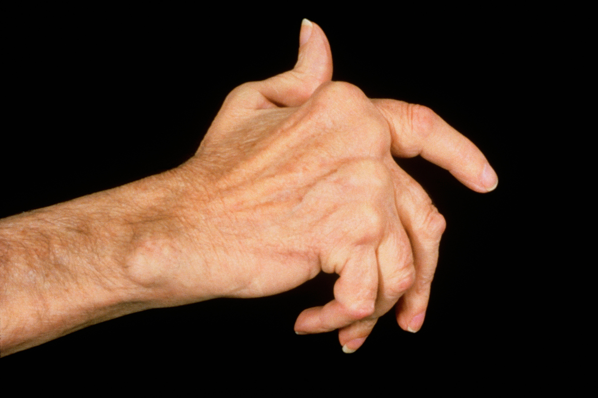 三孩生育政策来了，育龄期妇女如何预防产后风湿？