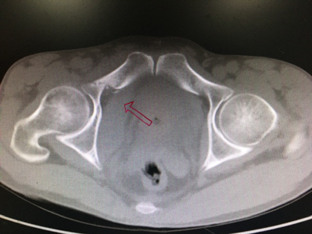 一名骨科医生股骨骨折经历,骨科朱医生