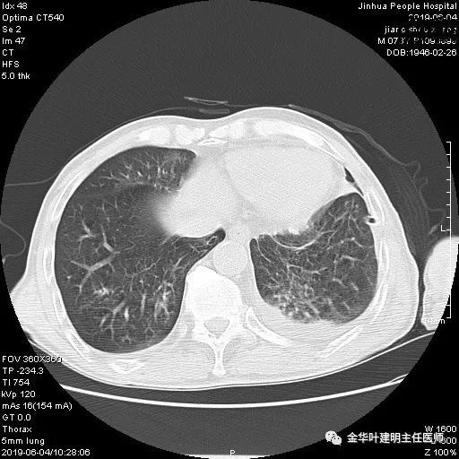 肺手术后乳糜胸是医疗事故吗,肺部切除后乳糜胸治好了