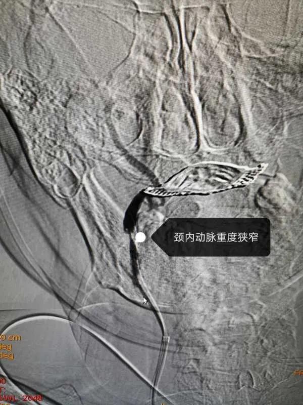 取栓急诊手术,急救92岁老人取栓成功创奇迹