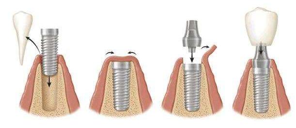 做种植牙要一直张嘴吗,做种植牙需要磨牙吗