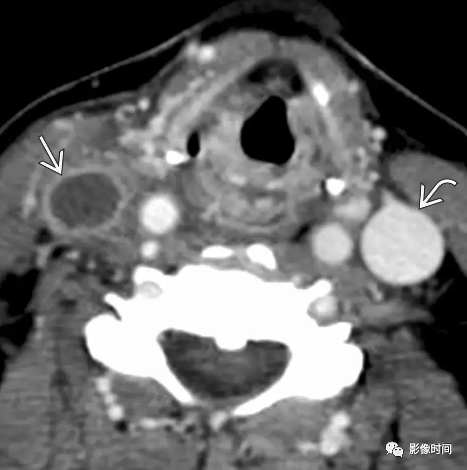 双侧颈动脉鞘间隙多发小淋巴结影,双侧颈动脉间隙多软组织密度结节