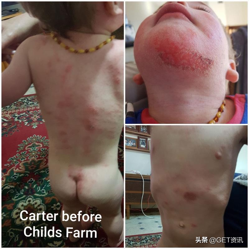 国外宝宝湿疹治疗,澳洲婴幼儿湿疹