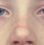 过敏性鼻炎眼袋黑,为什么儿童过敏性鼻炎下眼袋发黑