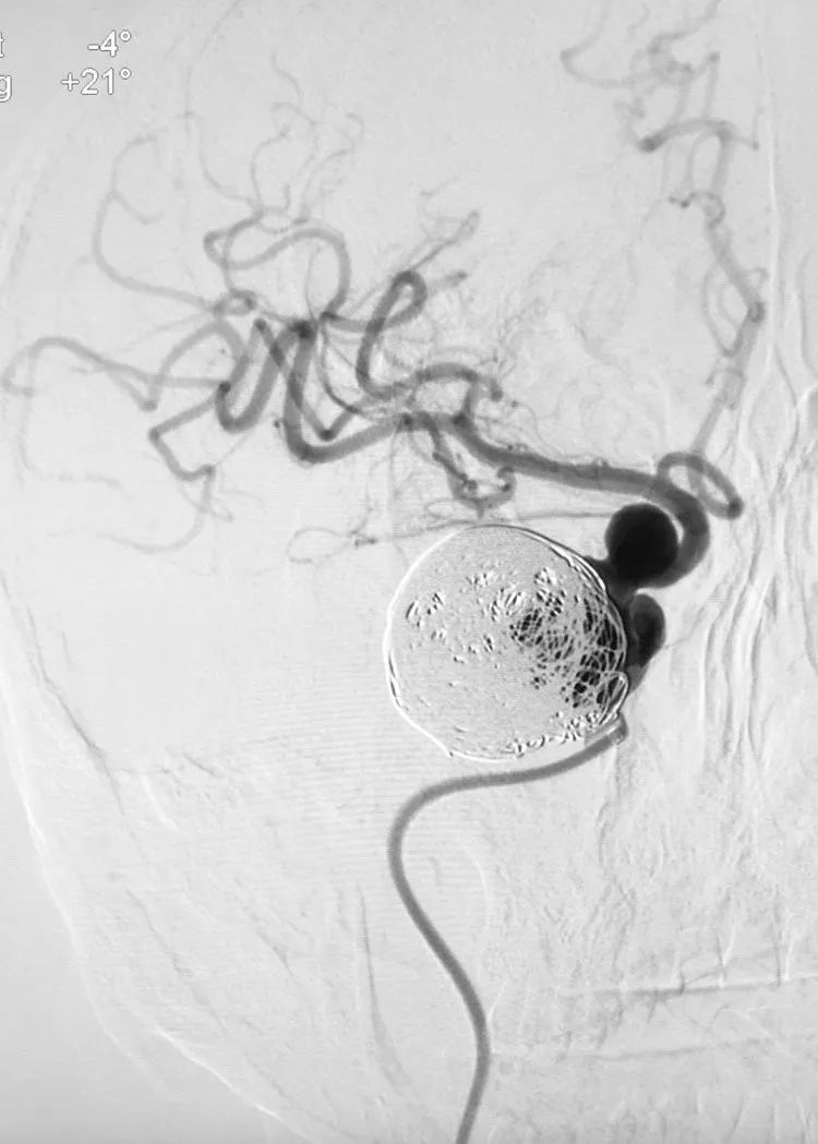 国外怎么治疗动脉瘤,全世界颅内动脉瘤最佳的治疗