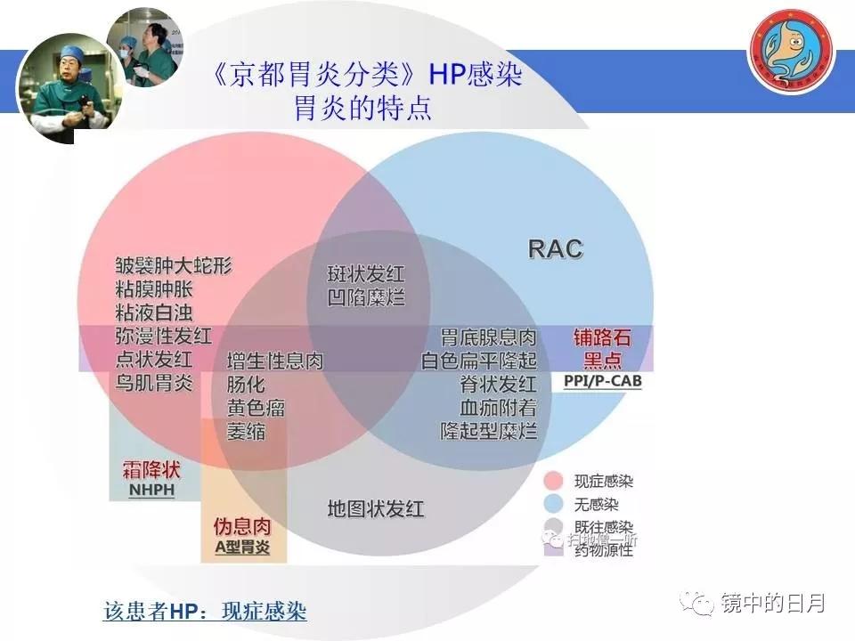 低分化胃癌早期时候做内镜手术吗,早期胃癌内镜手术后追加外科手术
