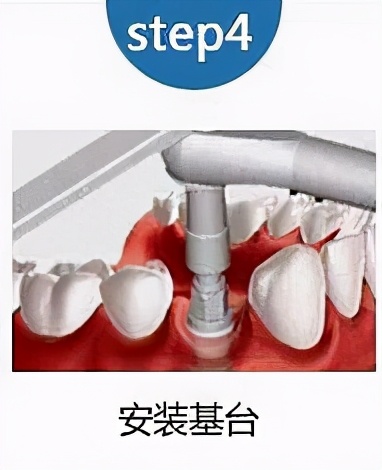 老人家种牙去哪里最好,50岁种牙最好方法怎么种