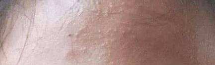 怎么去闭口粉刺痘痘脂肪粒,护肤毛孔粗大闭口怎么补救