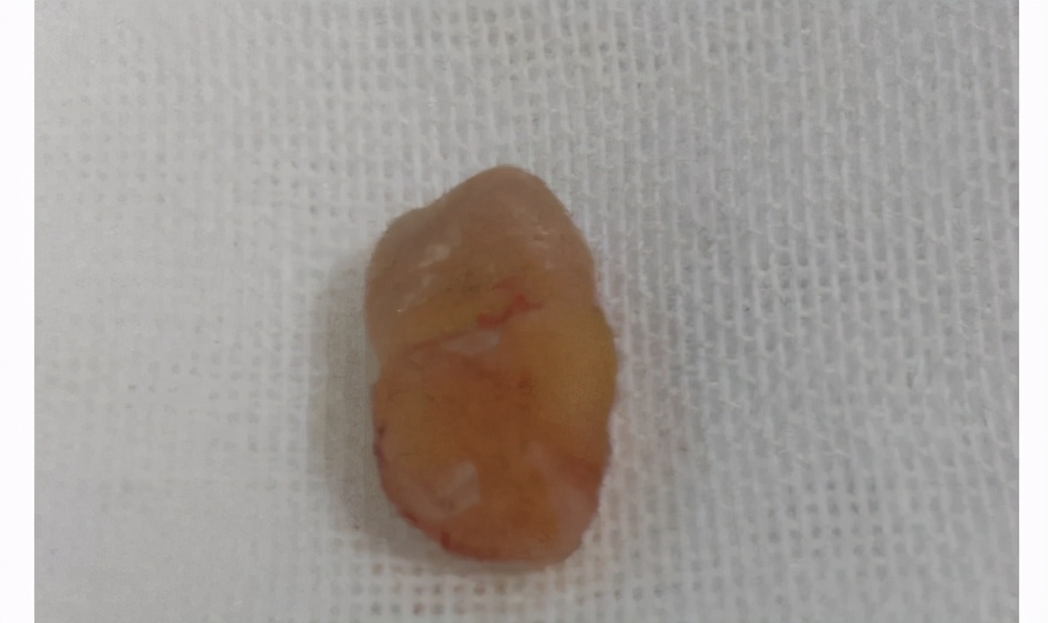 鼻窦囊肿导致脸部疼痛怎么办,鼻窦囊肿导致脸颊疼痛