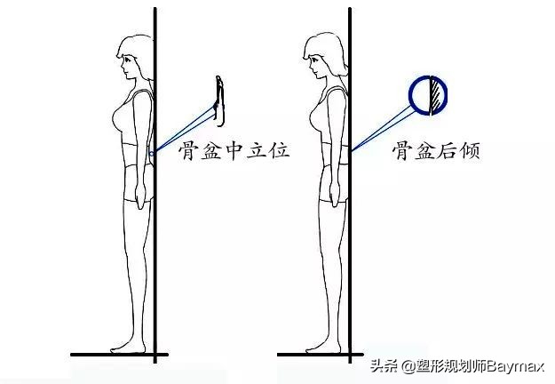 你以为的翘臀有可能是骨盆前倾,你以为的臀部训练