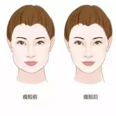 打瘦脸针脸真的能瘦吗,打瘦脸针脸真的瘦吗