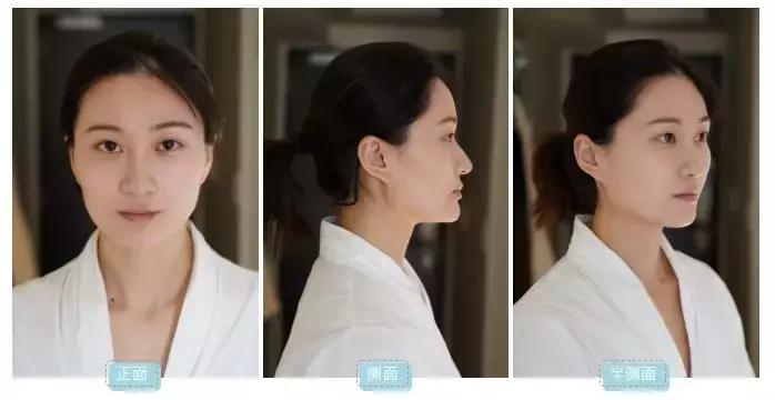 凹面型侧脸怎么改善,凹面型侧脸是怎么造成的